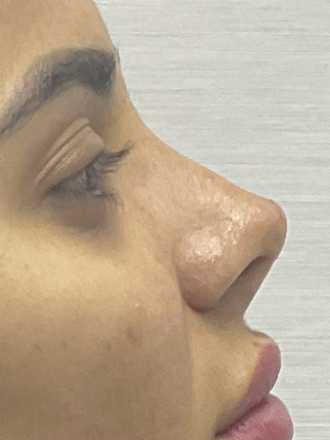 Rhinoplasty, After