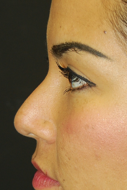 Rhinoplasty, Before