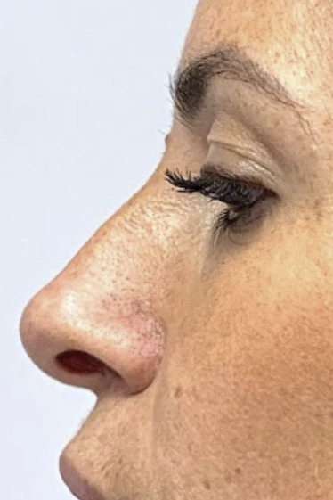Rhinoplasty, Before