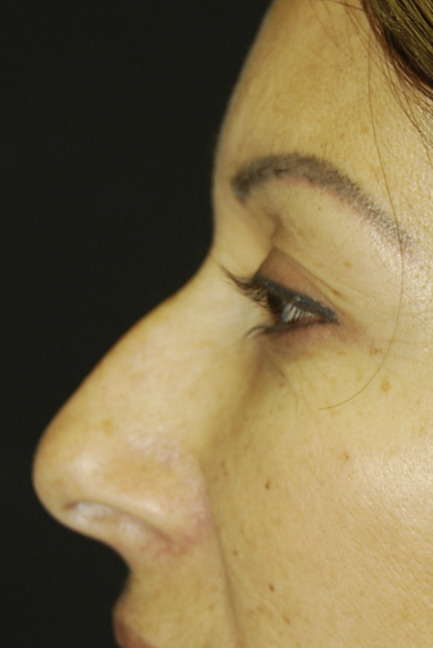 Rhinoplasty, Before