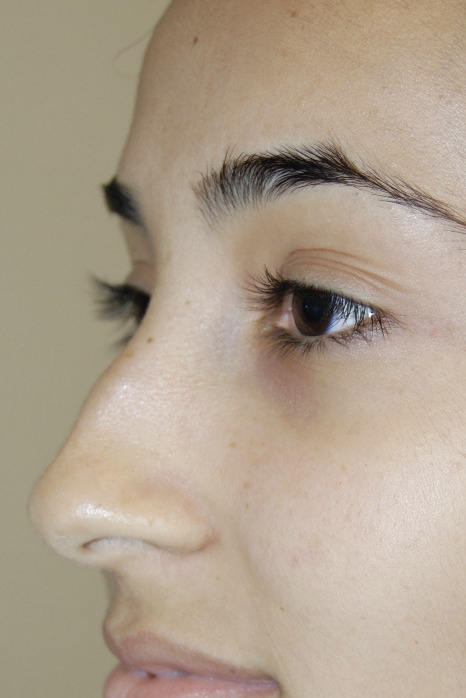 Rhinoplasty, Before