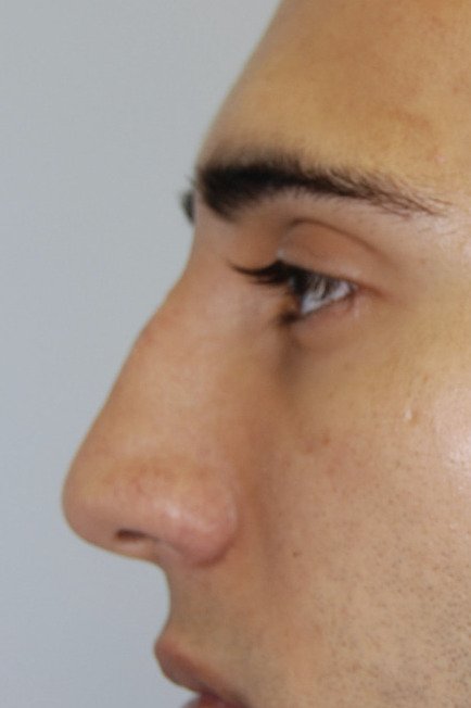 Rhinoplasty, Before