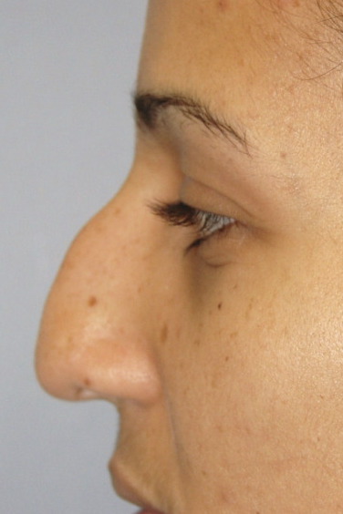 Rhinoplasty, Before