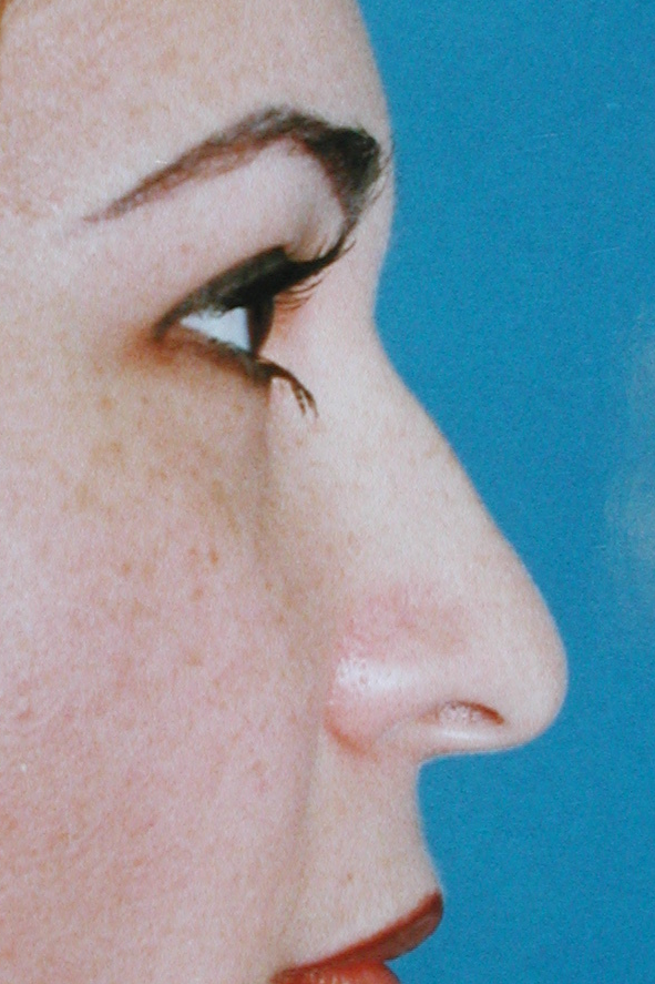 Rhinoplasty, Before