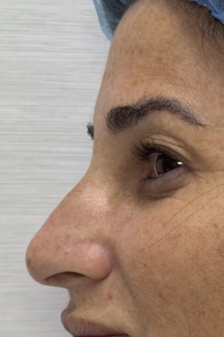 Rhinoplasty, Before