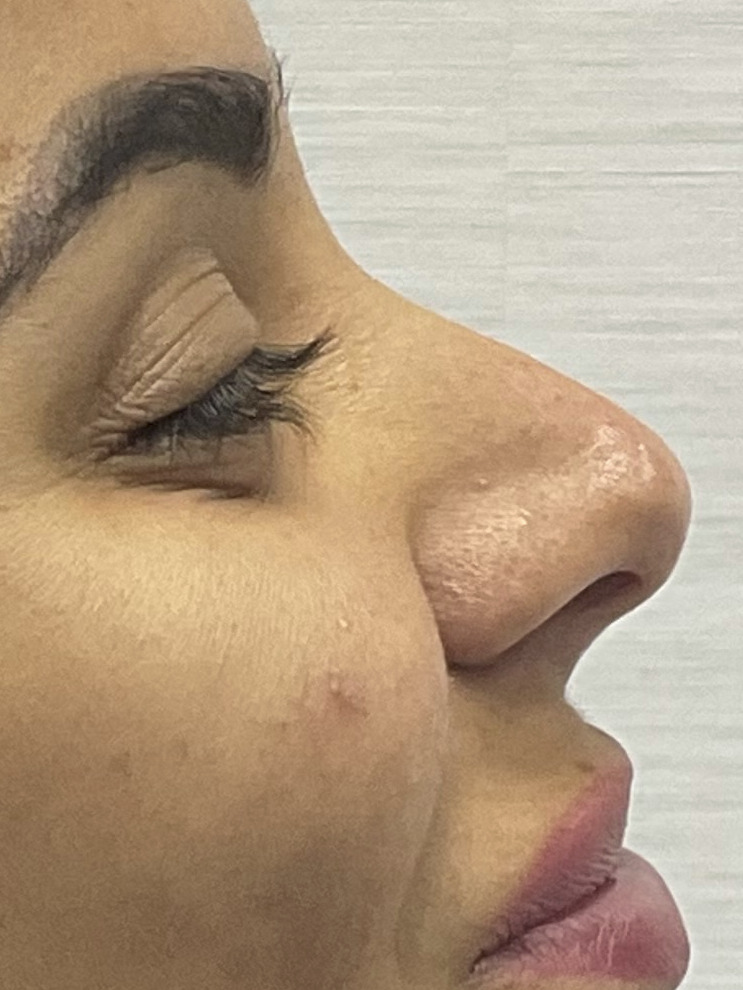 Rhinoplasty, Before