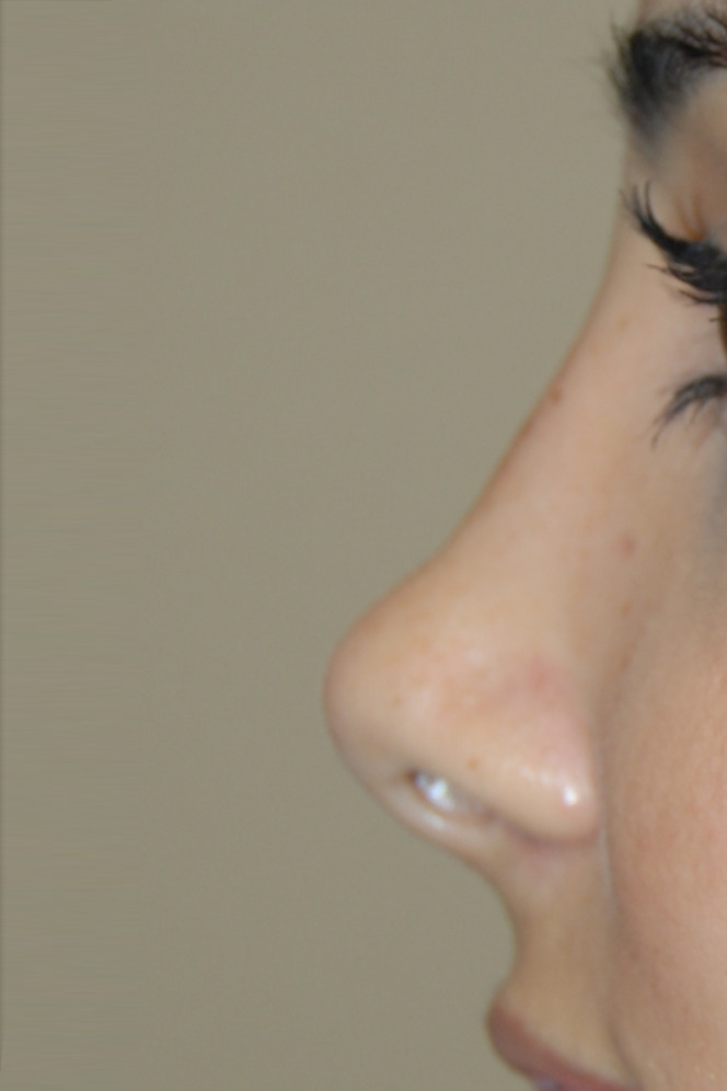 Rhinoplasty
