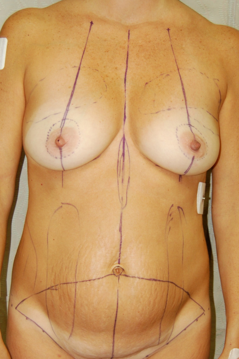 Tummy Tuck, Before
