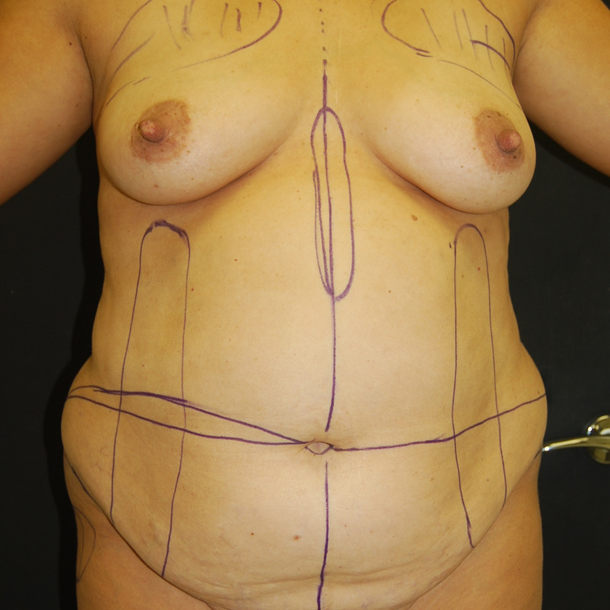 Tummy Tuck, Before